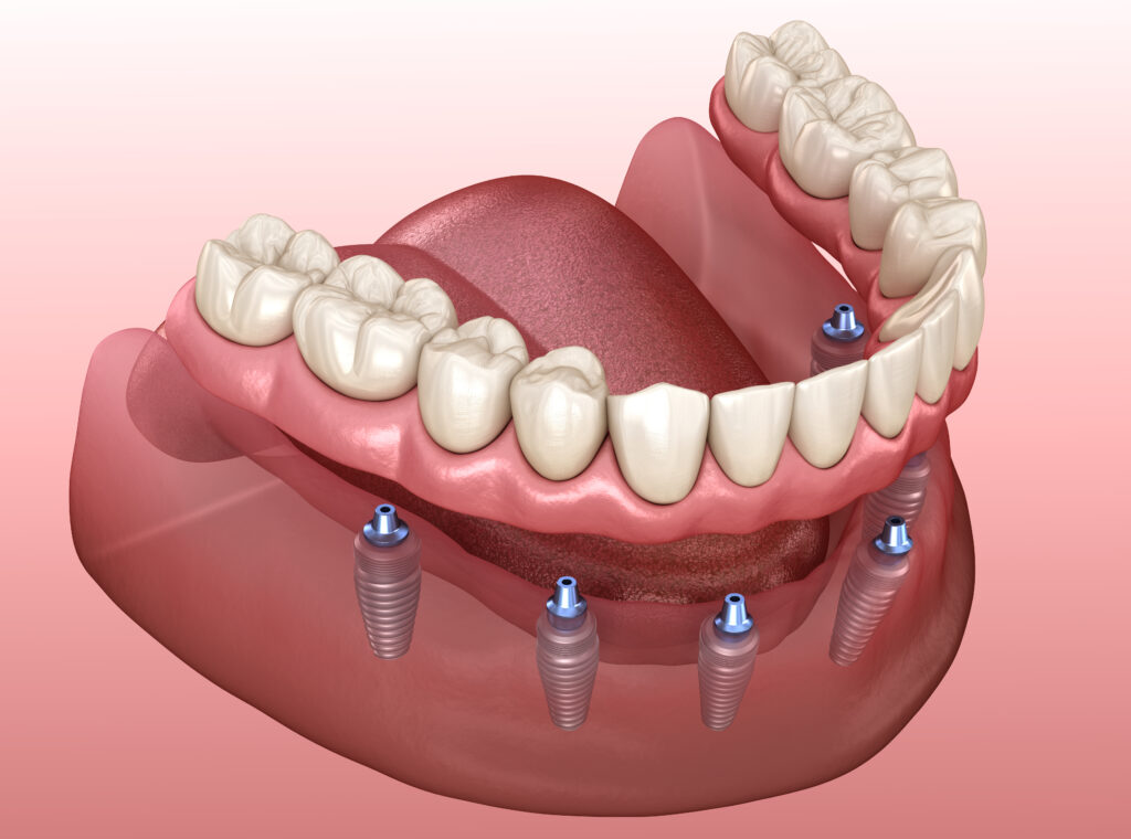 The Benefits Of Implant Dentures Livonia MI