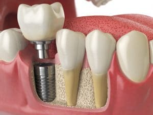 dental implant and crown
