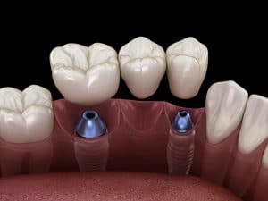 dental implant bridge