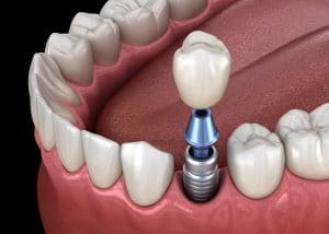 dental implant and crown