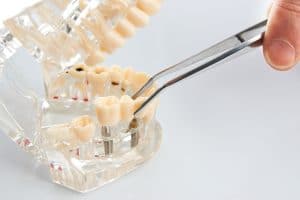 dental implant bridge