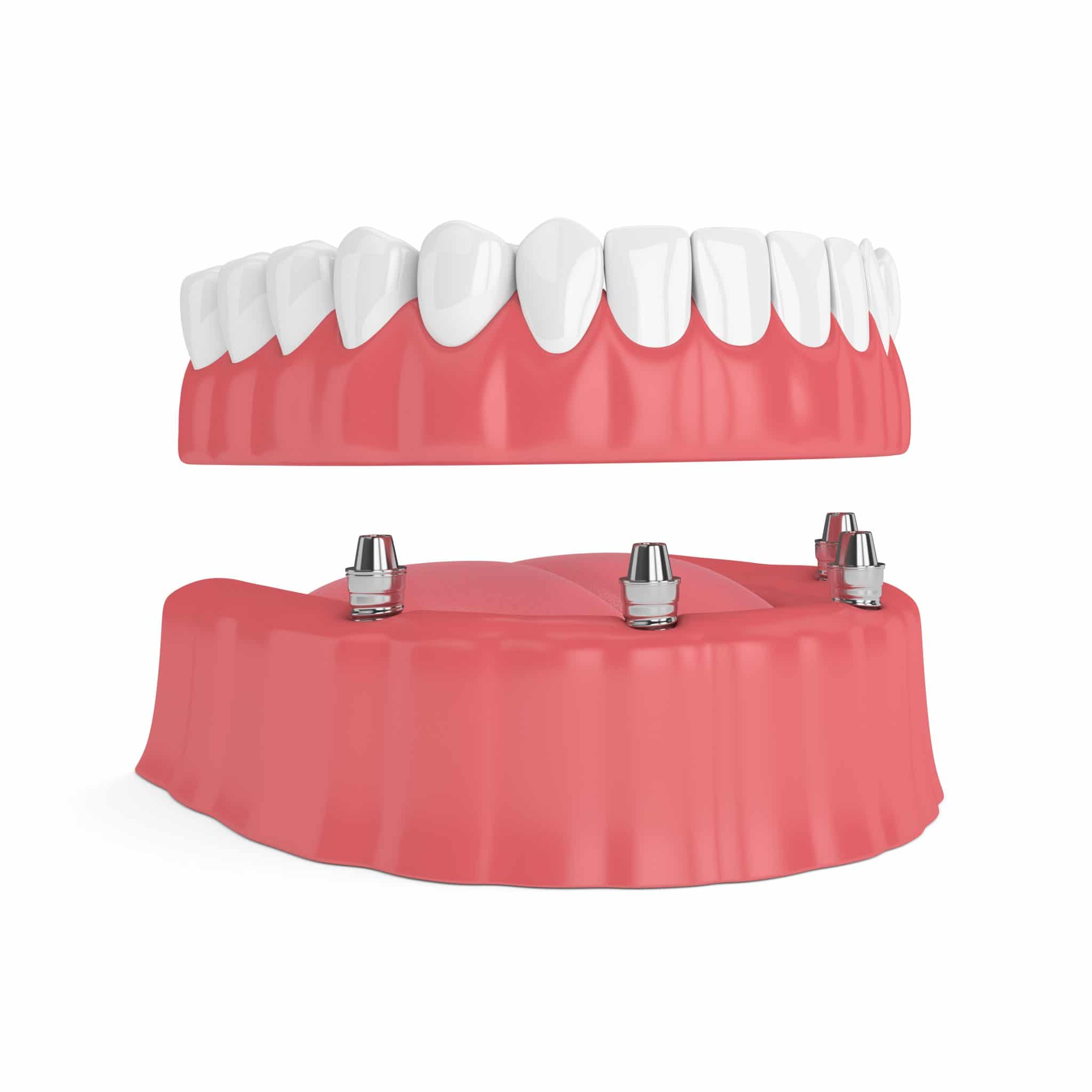 Livonia Dentist Secures Complete Dentures With Dental Implants Dr