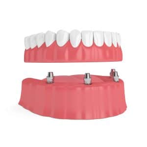 implant dentures