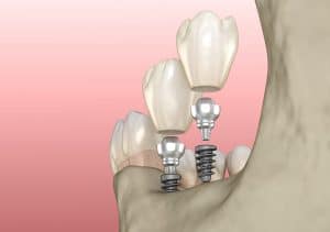 mini implants