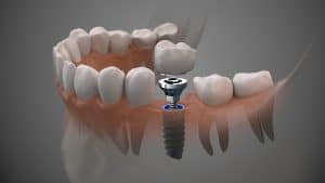 treating tooth loss with dental implant