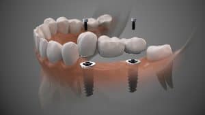 dental implant bridge