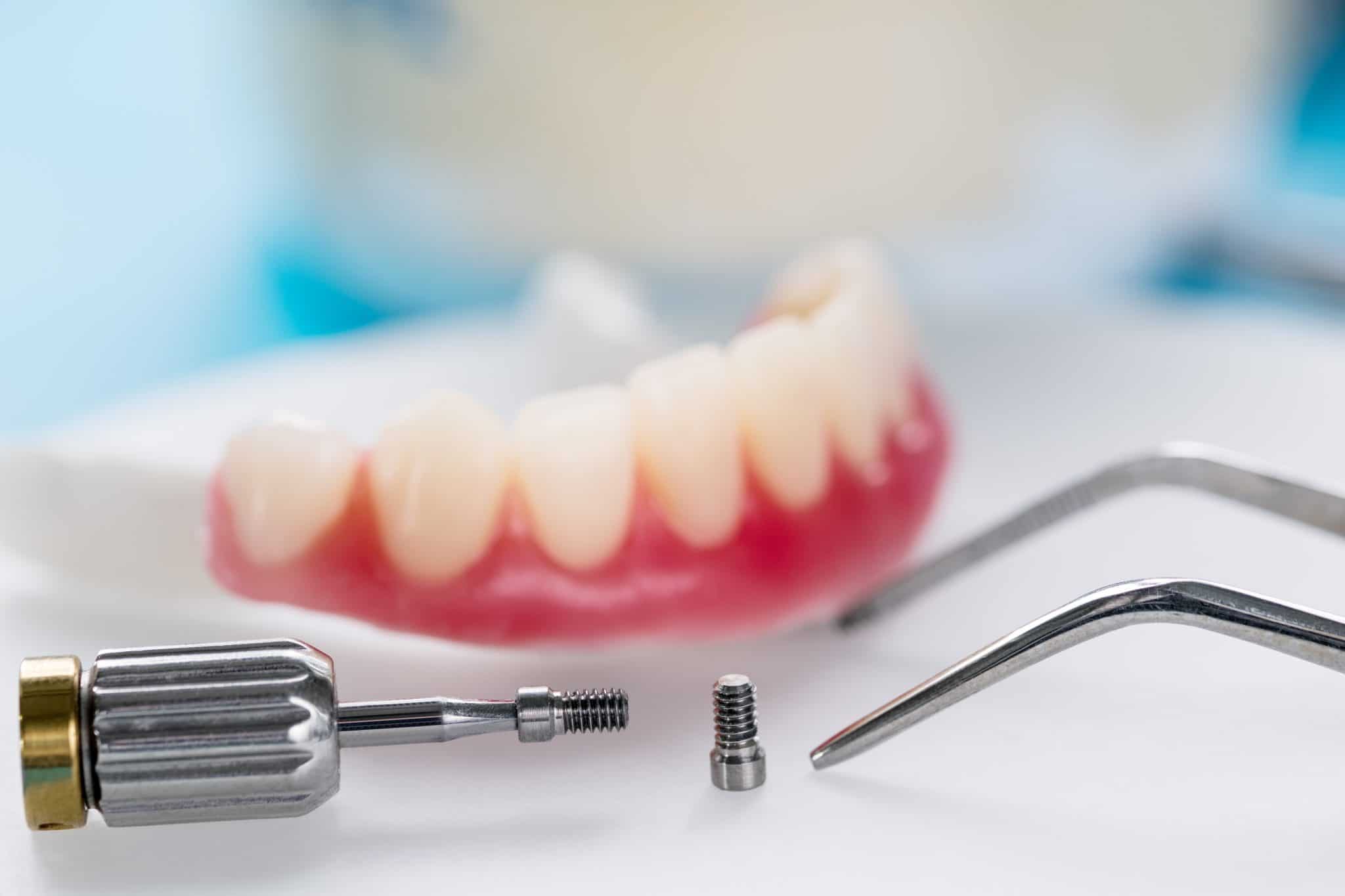 Livonia Dentist Provides Secure Bridges And Partials With Implants Dr. James Stewart Livonia, MI