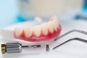 livonia implant bridges dentures