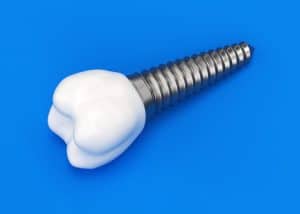 livonia embrace dental implants