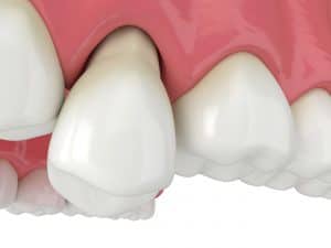 livonia tooth loss