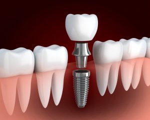 livonia dental implants