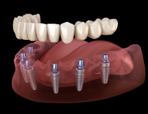livonia implant dentures