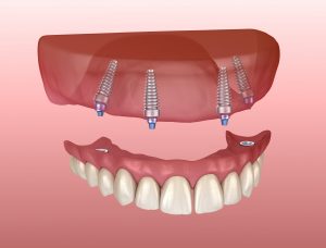 livonia teeth in a day