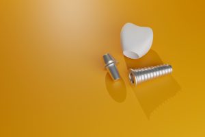 livonia dental implant parts