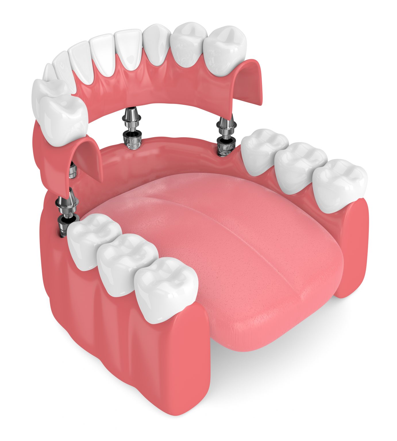 Using Dental Implants To Secure Full Dentures Livonia, MI