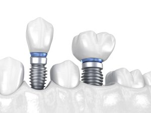 livonia mini implants