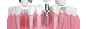 livonia implants and crowns