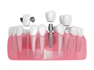 livonia implants and crowns