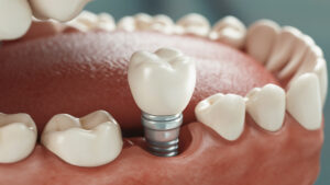 livonia dental implants