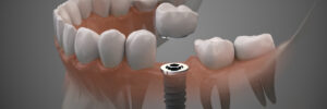 livonia dental implant