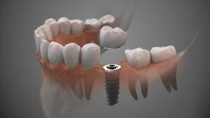 livonia dental implant