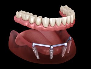 livonia teeth-in-a-day