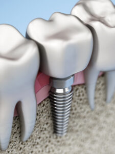 livonia dental implants