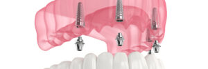 livonia all on four implant dentures