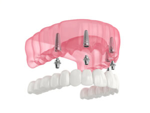 livonia all on four implant dentures