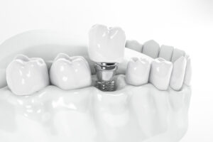 livonia dental implants