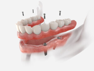 livonia implant dentures