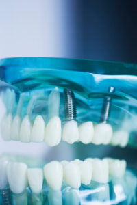 livonia dental implants