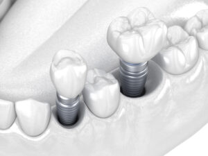 livonia mini dental implants