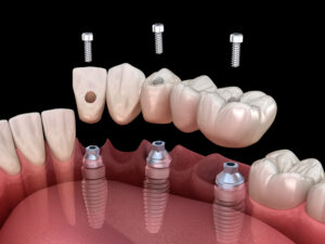 livonia implant bridge