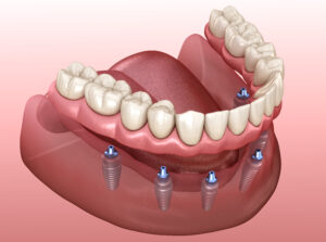 livonia implant dentures