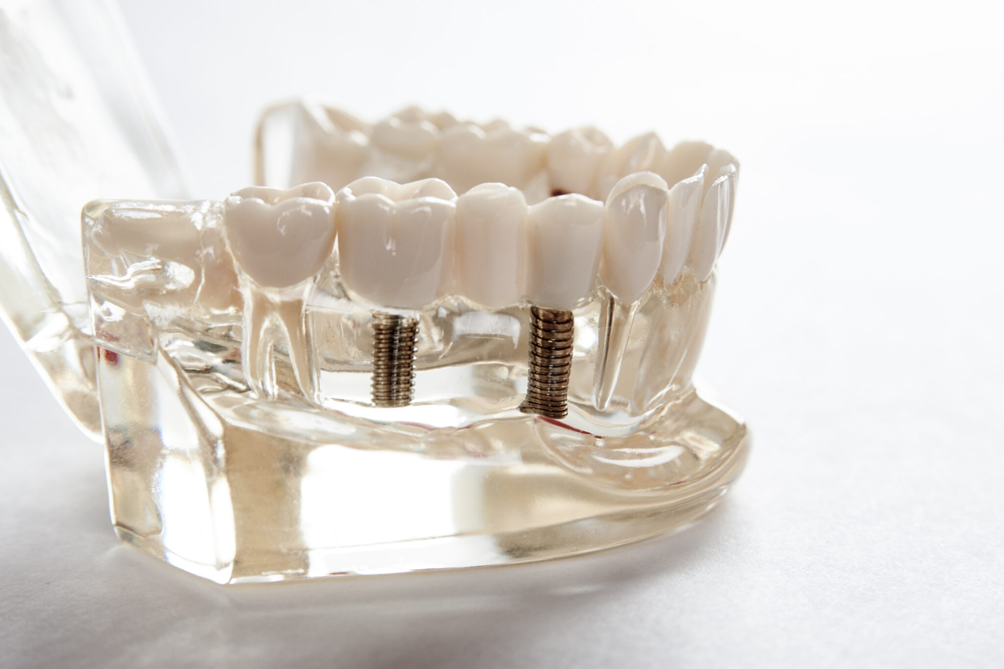 Is Your Smile Ready For Implant Partials? Livonia, MI
