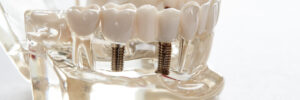 livonia partial implant dentures