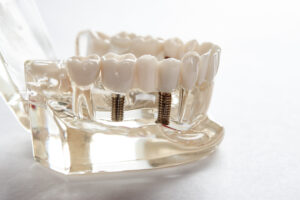 livonia partial implant dentures