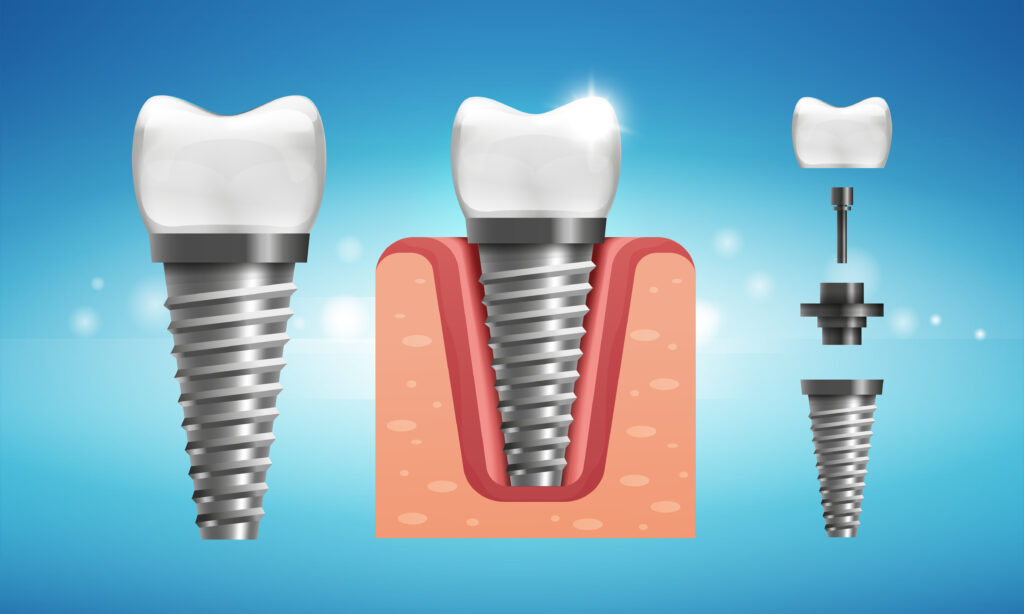 Let’s Examine The Three Parts Of An Implant | Livonia, MI