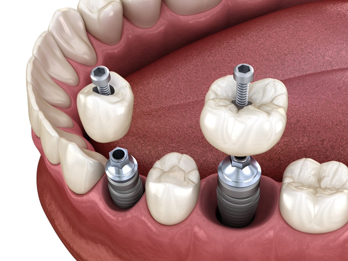 The Three Major Parts Of Your Dental Implant Livonia, MI