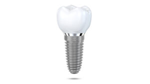 livonia dental implants