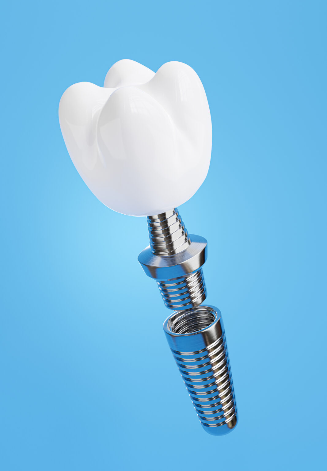 Securing Your Dental Implant And Crown | Livonia, MI