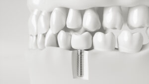 livonia dental implants