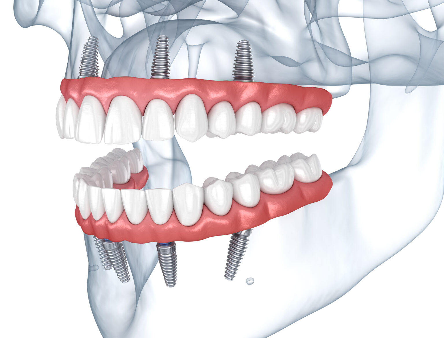 The Options We Provide For Implant Dentures Livonia, MI