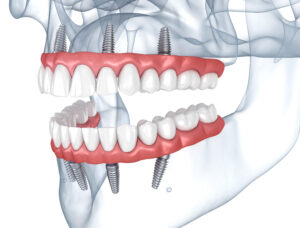 livonia implant dentures