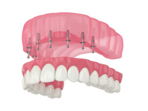 livonia implany dentures