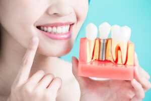 Receive Your Dental Implant in just one day with Dr.Stewart in Livonia, MI