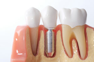 livonia dental implants