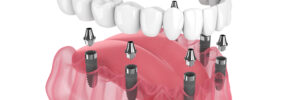 livonia dental implant dentures