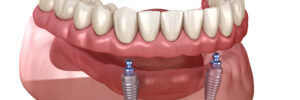 livonia dental implants
